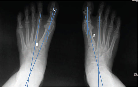 Case Study Finds %50 Improvement is Toe Angle | A Summary