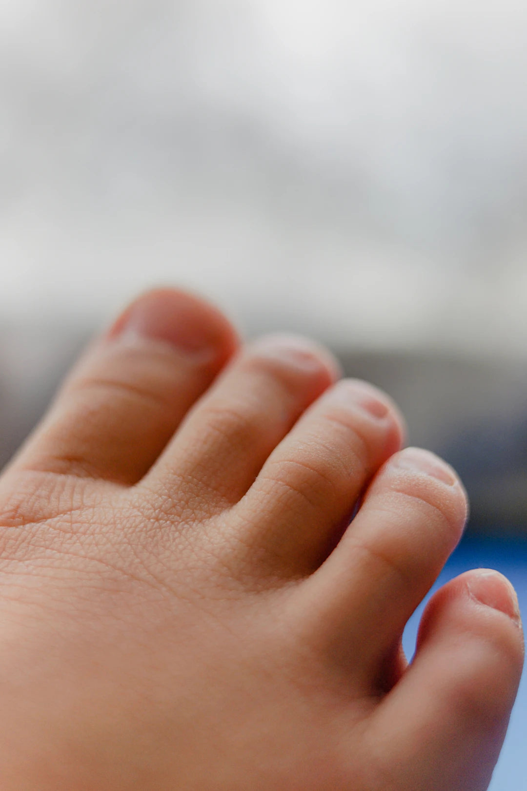 Smart Strategies Preventive Measures for Bunions