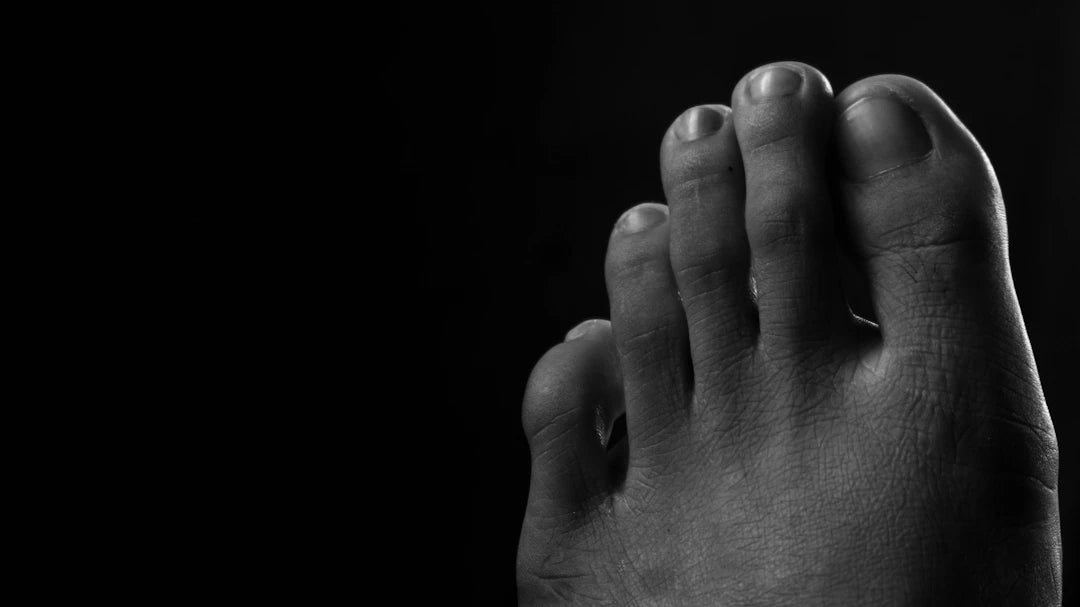 Truths Unveiled Common Myths About Bunions Debunked