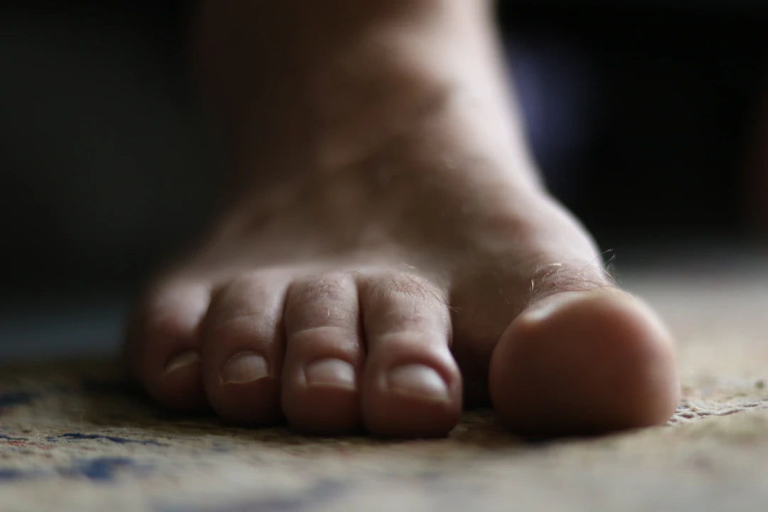 Lifestyle Changes to Reduce Bunion Discomfort