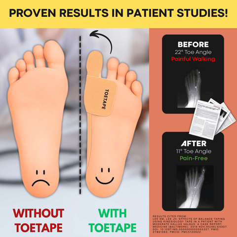 Bunion Relief Tape